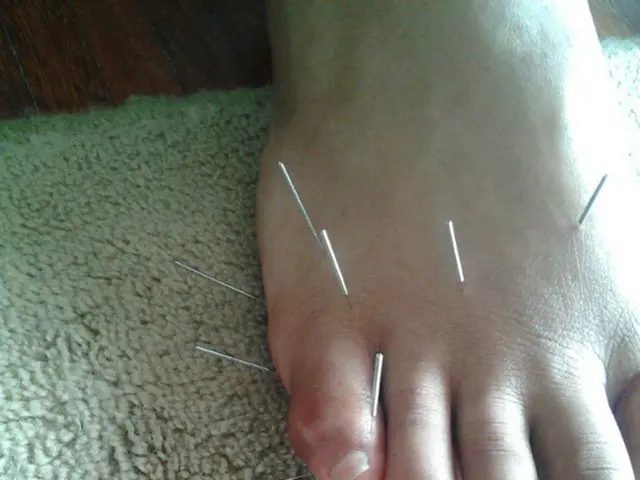 Venous Reflux Disorder: Signs, Remedies, and Further Details